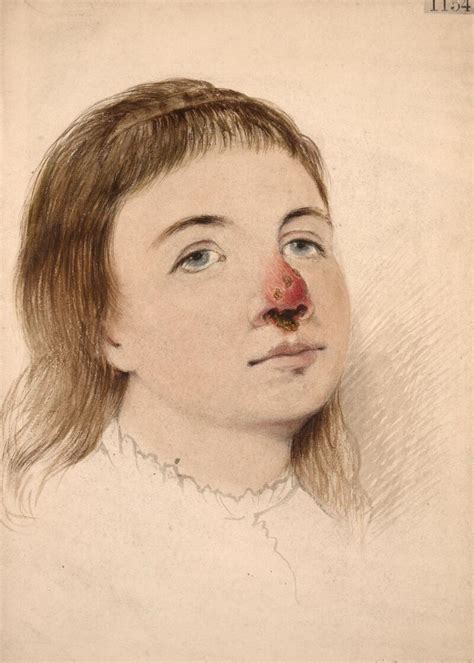 Ulceration Of The Nose The Result Of Congenital Syphilis Wellcome