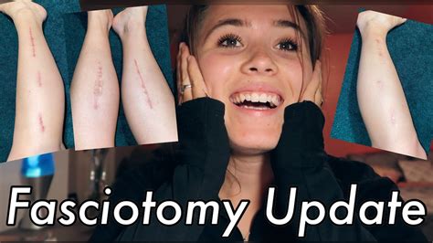 Fasciotomy Recovery Post Surgery Update From Chronic Exertional