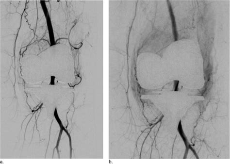Technically Successful Geniculate Artery Embolization Does Not Equate