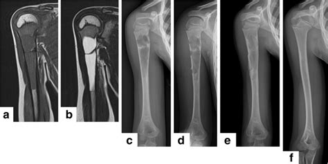 The Typical Case Of Simple Bone Cyst In The Right Humerus Treated With