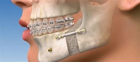 Jaw Surgery Archives The Look Orthodontics