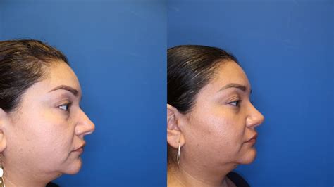 Nose Surgery Before And After Photos Patient 280 San Francisco Ca