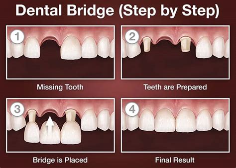 The Pros And Cons Of A Dental Bridge Dentist For Life