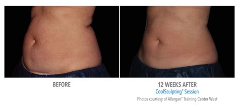 Coolsculpting Side Effects Long Term Images