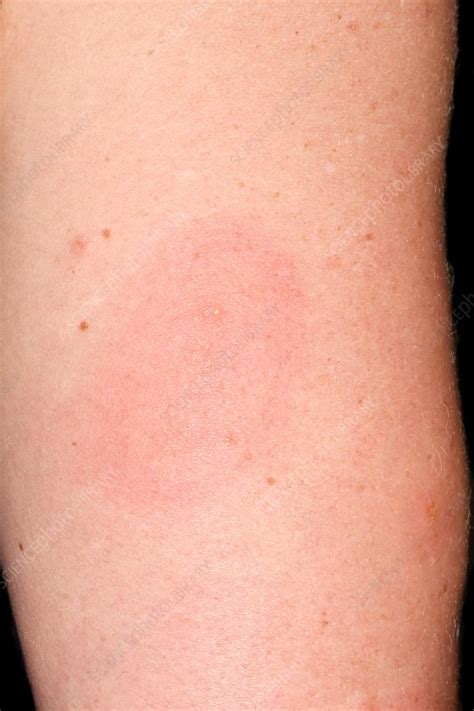 Urticaria Stock Image C0370862 Science Photo Library