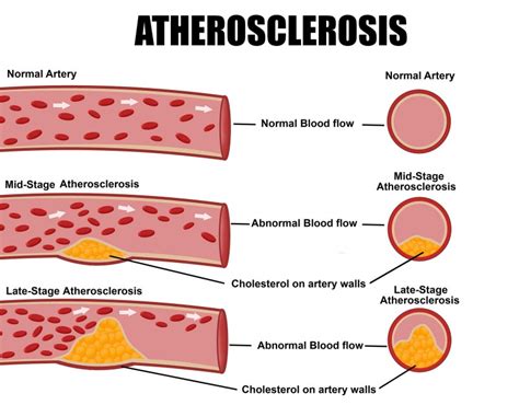 What Is Atherosclerosis And Its Associated Risk Factors