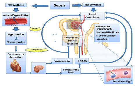 Sepsis is a serious medical condition. Sepsis & AKI