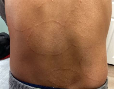 Clinical Challenge Expanding Raised Rash Mpr