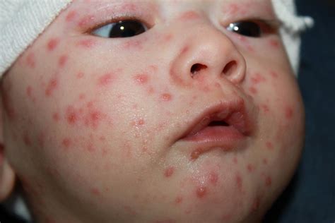 Patients and the general population should be instructed regarding the importance of early presentation and. Chickenpox in babies: Pictures, symptoms, and treatments
