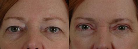 Eyelid Surgery Blepharoplasty Before And After Pictures Case 26