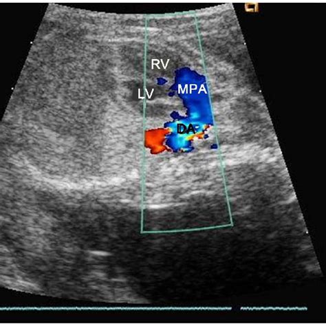 2D Color Doppler Fetal Echocardiographic Image Showing Turbulence In