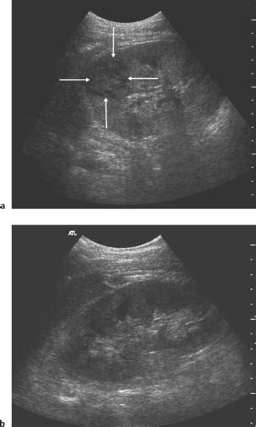 Decrease in symptoms' severity (symptomatic treatment). Parenchymal Diseases of the Kidney | Radiology Key