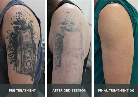 Update Tattoo Laser Removal Before And After In Eteachers