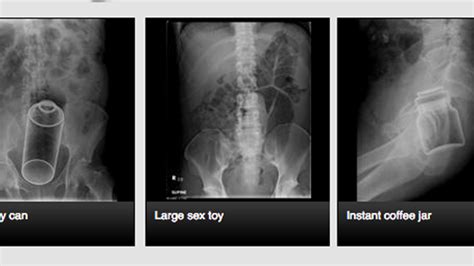 The Site Where Doctors Share X Rays Of Weird Things In Peoples Butts