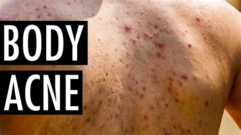 How To Get Rid Of Body Acne Tips To Prevent Body Acne Tiege Hanley