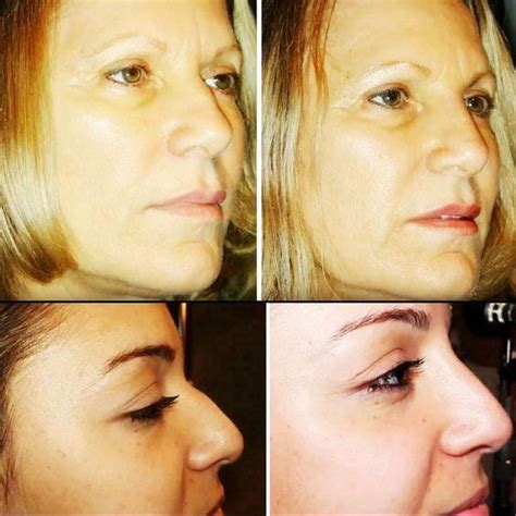 Botox Facelift Before And After Pictures 1 Facelift Info Prices
