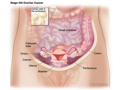 This is the most common form of ovarian cancer and occurs primarily in adults. IP Chemo for Ovarian Cancer is Underused - National Cancer ...