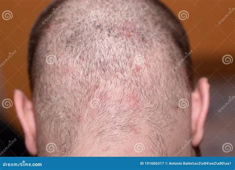 Back Side Of A Man S Head Suffering From Scalp Acne Stock Image Image