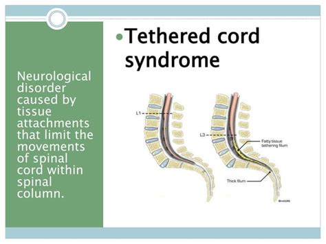 Developmental Disease Of Spinal Cord Ppt