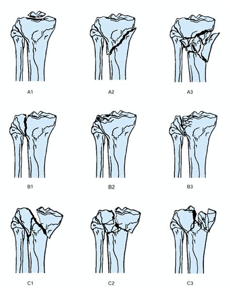Fractures Of The Tibial Plateau Teachme Orthopedics