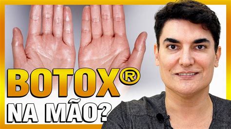 Botox® Na Mão Toxina Botulínica Para Hiperidrose Palmar Youtube