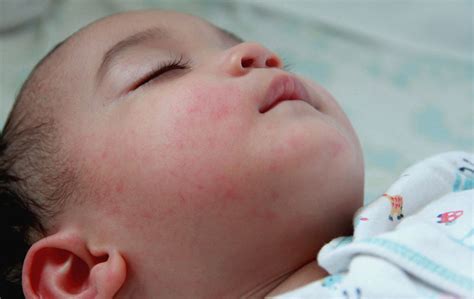 Healthguidetips Eczema In Children Overview Tests And Beneficial