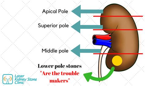 The 4 Methods Of Kidney Stone Removal Kidney Stones Clinic
