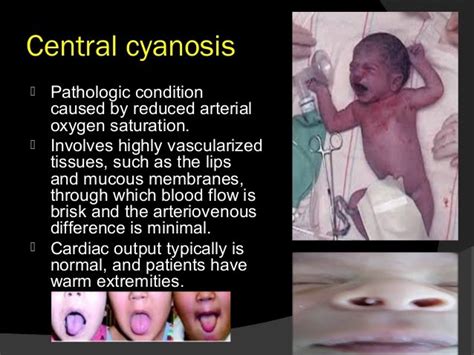 Approach To A Neonate With Cyanosis