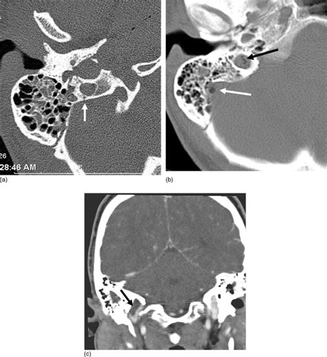 Imaging Of Blunt Cerebrovascular Injuries European Journal Of Radiology