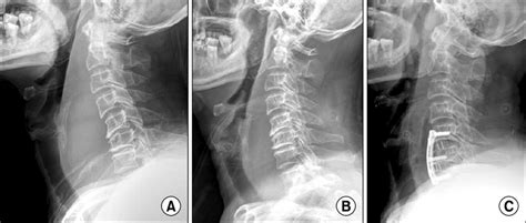 A Initial C Spine Lateral Radiograph Shows Extensive Prevertebral
