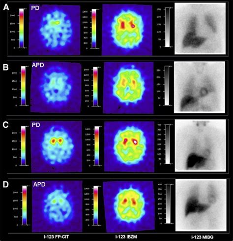 Fact Sheet Molecular Imaging And Parkinsons Disease Snmmi