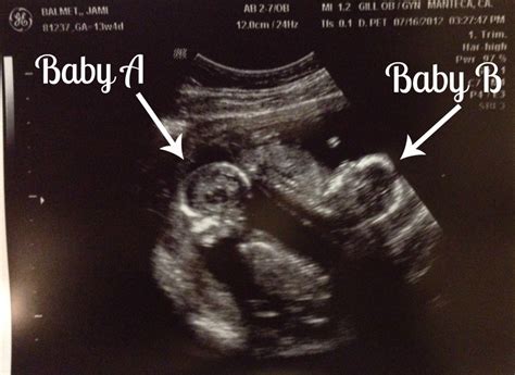 21 weeks pregnant with twins ultrasound
