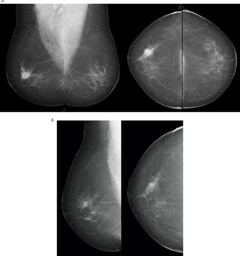 A Bilateral Mlo And Cc And Compression Magnification Diagnostic
