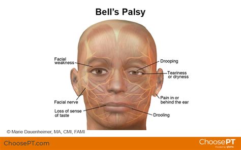 Guide Physical Therapy Guide To Bells Palsy 2022