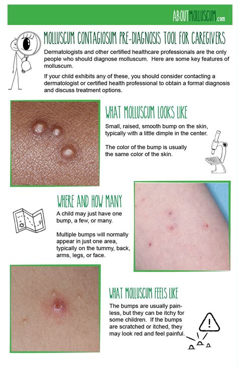 Stages Of Molluscum Contagiosum