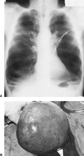 Bullous And Bleb Diseases Of The Lung Thoracic Key