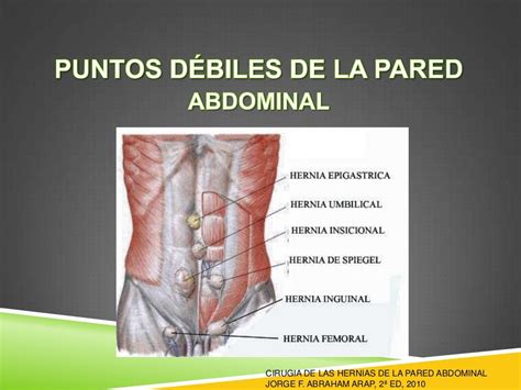 Ventral Umbilical Hernia