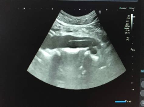 Vietnamese Medic Ultrasound Case Aortic Dissection Dr Phan Thanh My