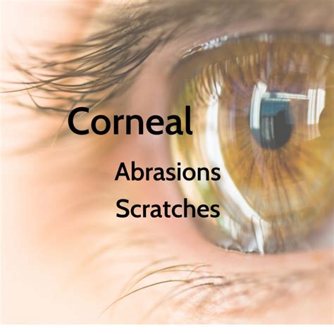 Corneal Scratches And Abrasions Signs Symptoms Board Certified Eye