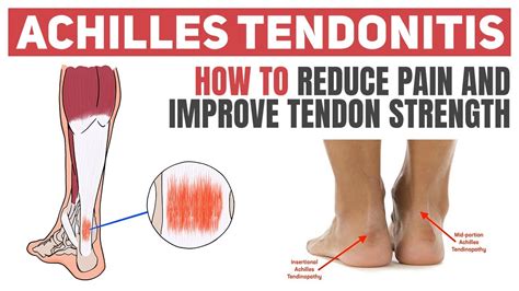 Achilles Tendinitis Exercises To Heal And Strengthen Your Tendon