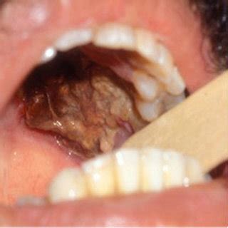 Learn more about mucormycosis and get advise for mucormycosis. Manifestations of herpes zoster ophthalmicus. (A) Herpes ...