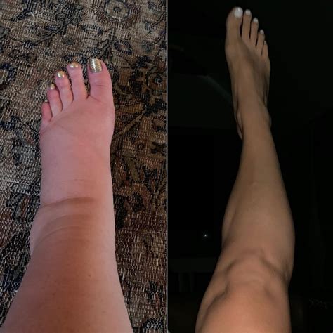 List 97 Pictures Photos Of Swollen Ankles Completed