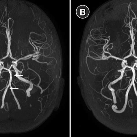 A Magnetic Resonance Angiography Mra Of The Brain Showing Diffuse