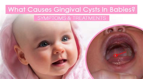 Little White Bumps What Causes Gingival Cysts In Babies Top