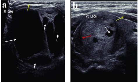 Ultrasound Features Of A Colloid Thyroid Lesion Panel A Showing