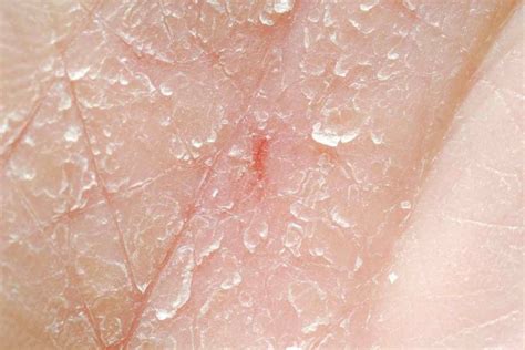 Itchy Skin At Night Causes And Treatments