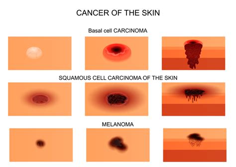 How Many Forms Of Skin Cancer Are There CancerWalls