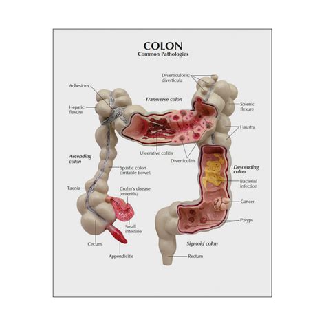 Most colon polyps are harmless. Modelo de Cólon Patologias Intestinais | MogiGlass ...
