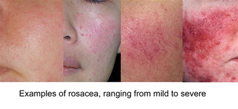 Rosacea Stop Hiding And What You Can Do To Fix It Platinum Skin Care