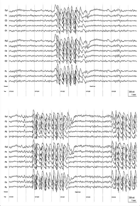 Interictal Eeg Of Patient Jl Sequential Pages Of The Eeg Showing